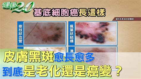 腳背黑斑|皮膚斑點愈長愈多，要不要緊？